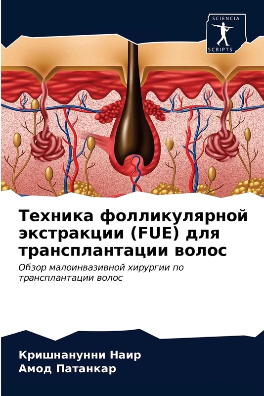 Техника фолликулярной экстракции (FUE) для трансплантации волос: Обзор малоинвазивной хирургии по трансплантации волос: Obzor maloinwaziwnoj hirurgii po transplantacii wolos