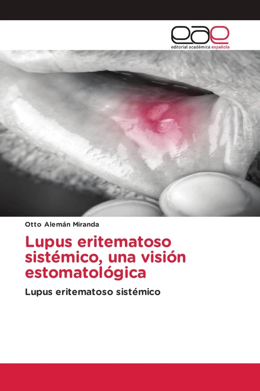 Lupus eritematoso sistémico, una visión estomatológica: Lupus eritematoso sistémico - Image 1