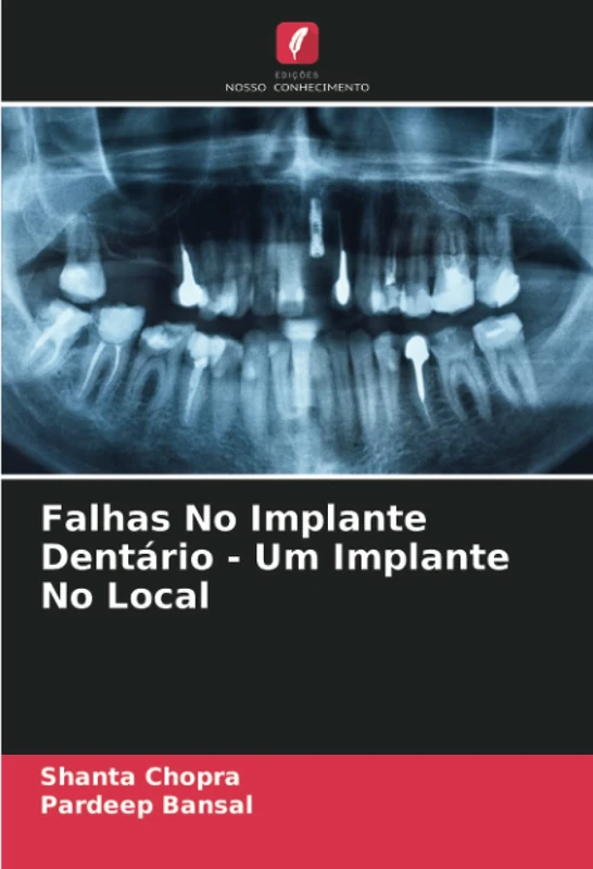 Falhas No Implante Dentário - Um Implante No Local