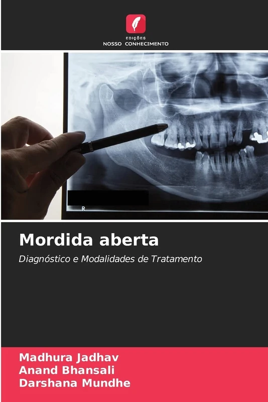 Mordida aberta: Diagnóstico e Modalidades de Tratamento - Image 1