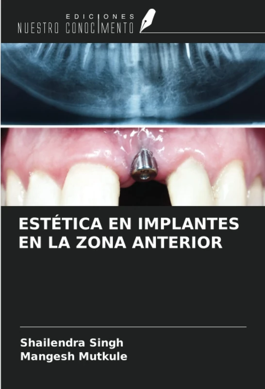 ESTÉTICA EN IMPLANTES EN LA ZONA ANTERIOR