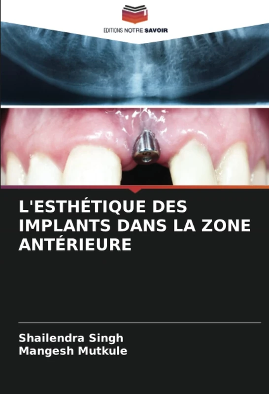 L'ESTHÉTIQUE DES IMPLANTS DANS LA ZONE ANTÉRIEURE