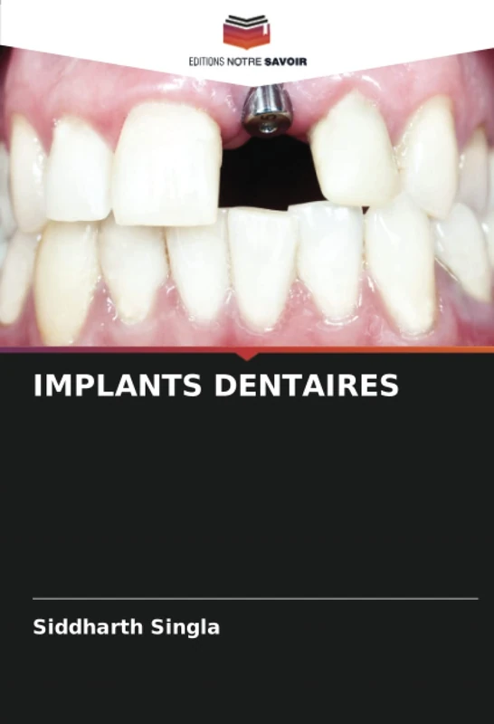 IMPLANTS DENTAIRES