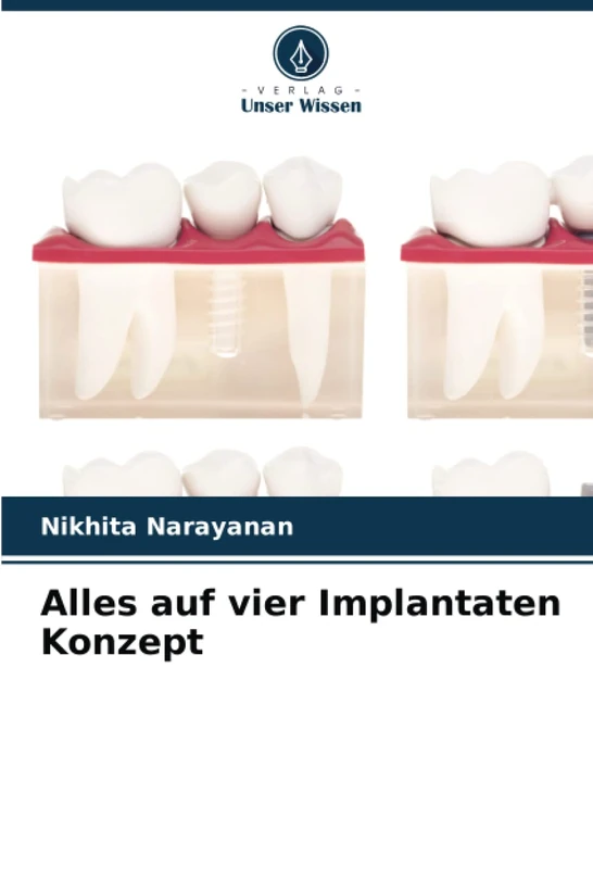 Alles auf vier Implantaten Konzept