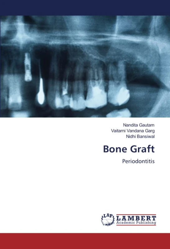 Bone Graft: Periodontitis