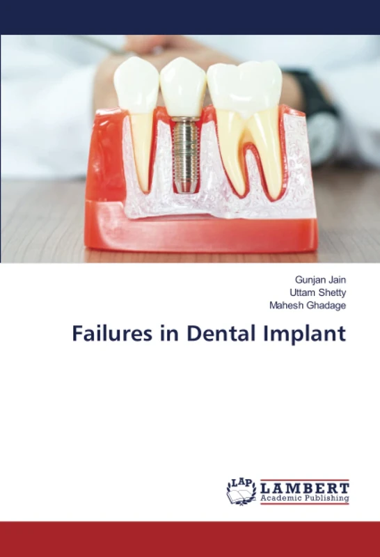 Failures in Dental Implant