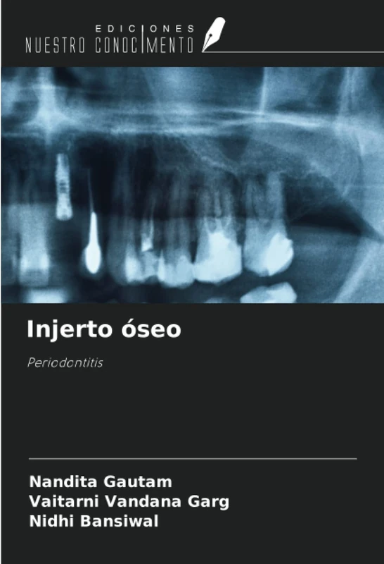 Injerto óseo: Periodontitis
