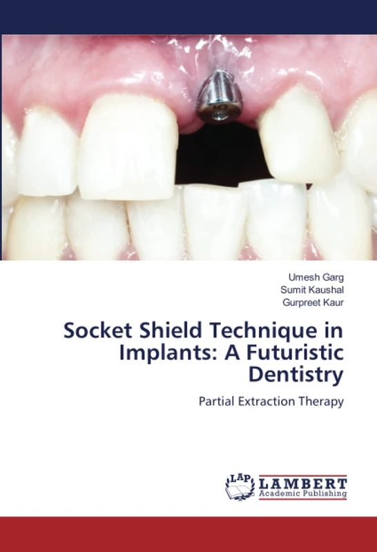 Socket Shield Technique in Implants: A Futuristic Dentistry: Partial Extraction Therapy