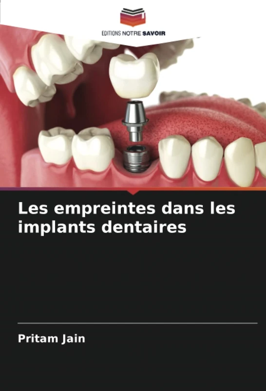 Les empreintes dans les implants dentaires