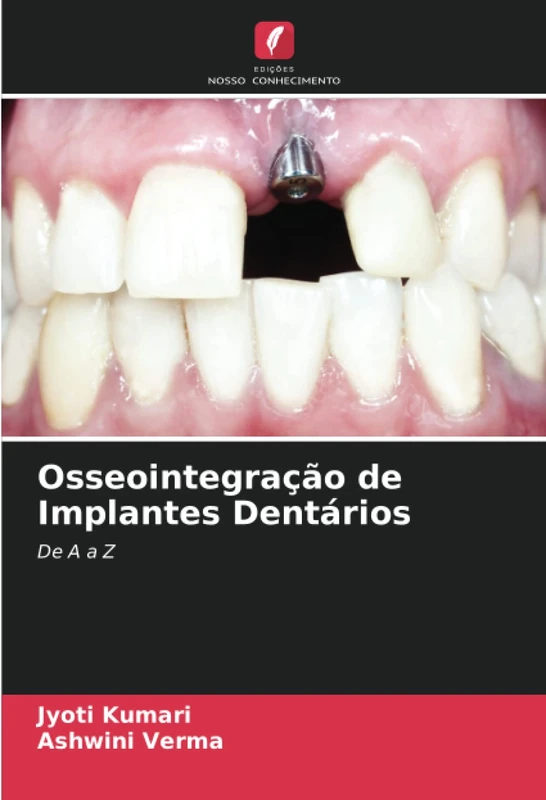 Osseointegração de Implantes Dentários: De A a Z - Image 1