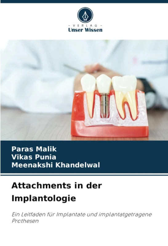 Attachments in der Implantologie: Ein Leitfaden für Implantate und implantatgetragene Prothesen