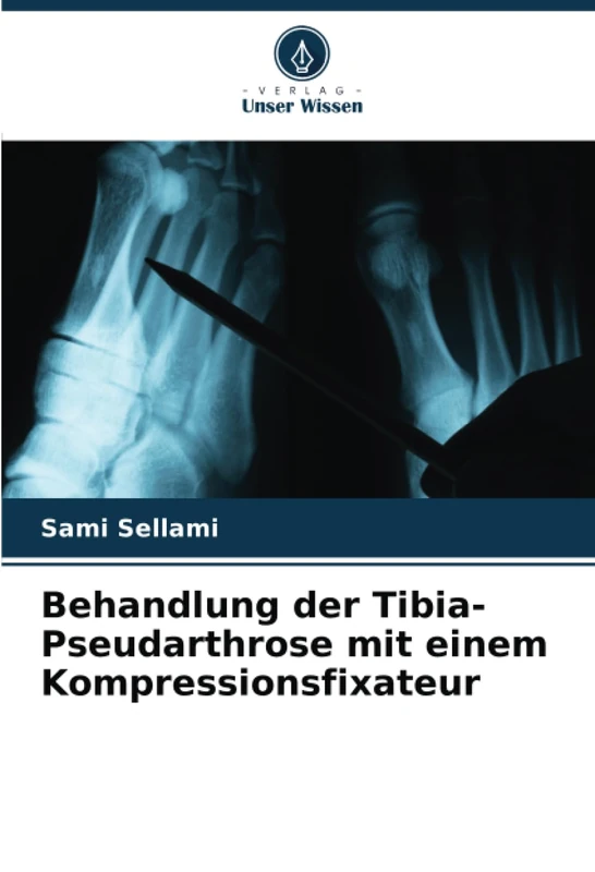 Behandlung der Tibia-Pseudarthrose mit einem Kompressionsfixateur - Image 1