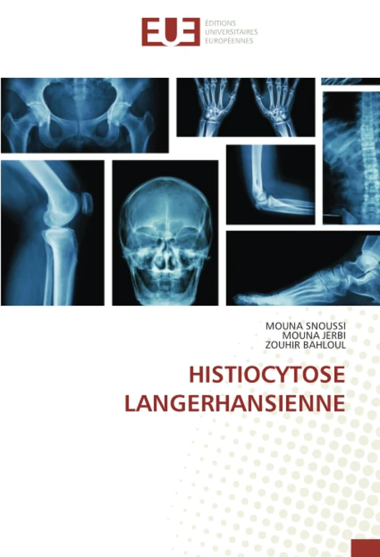 HISTIOCYTOSE LANGERHANSIENNE