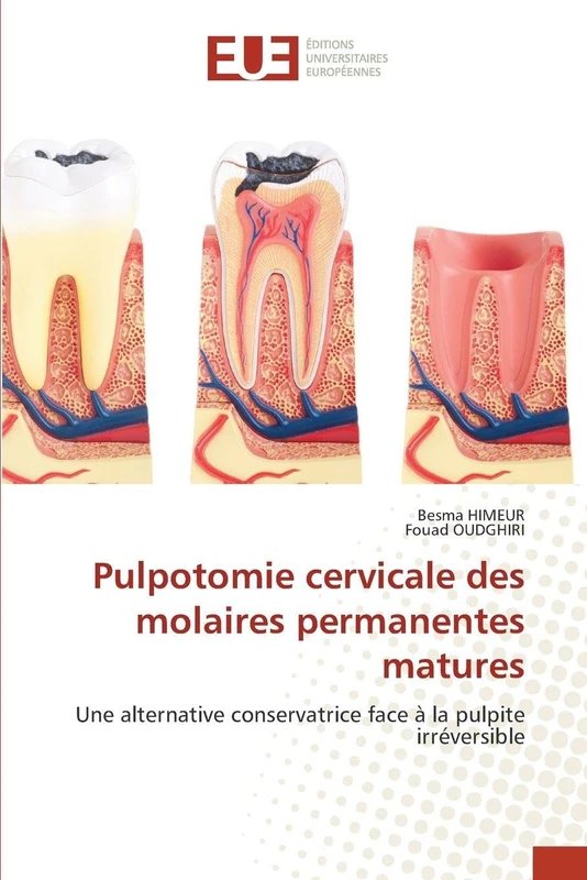 Pulpotomie cervicale des molaires permanentes matures: Une alternative conservatrice face à la pulpite irréversible - Image 1