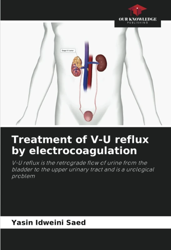 Treatment of V-U reflux by electrocoagulation: V-U reflux is the retrograde flow of urine from the bladder to the upper urinary tract and is a urological problem