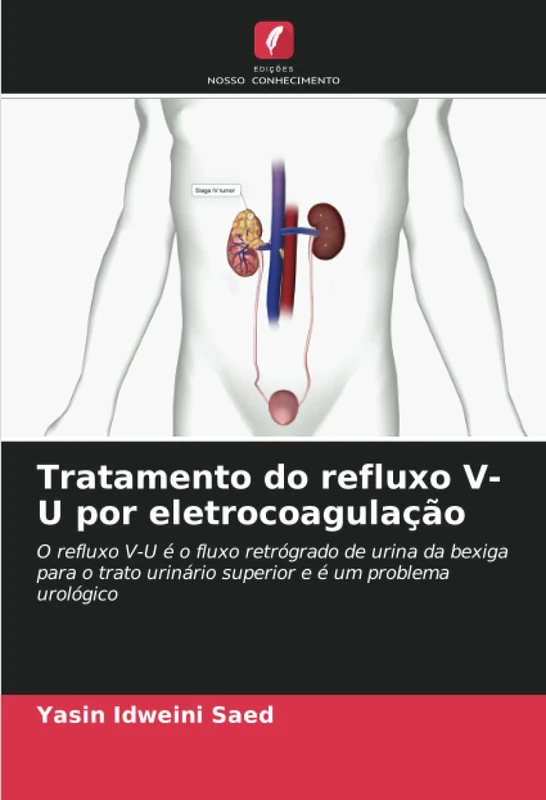 Tratamento do refluxo V-U por eletrocoagulação: O refluxo V-U é o fluxo retrógrado de urina da bexiga para o trato urinário superior e é um problema urológico - Image 1