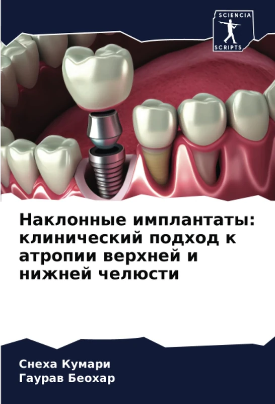 Наклонные имплантаты: клинический подход к атропии верхней и нижней челюсти