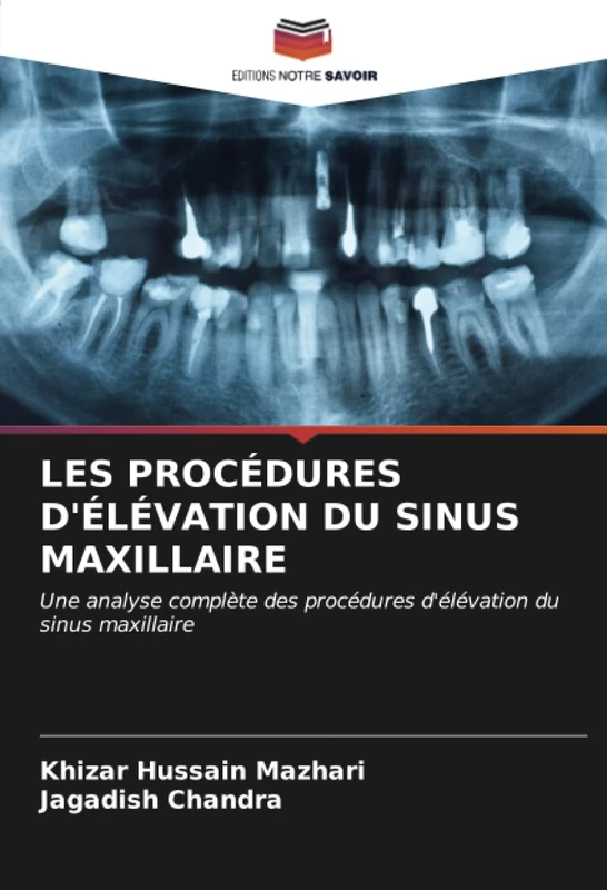 LES PROCÉDURES D'ÉLÉVATION DU SINUS MAXILLAIRE: Une analyse complète des procédures d'élévation du sinus maxillaire