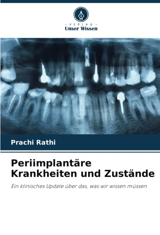 Periimplantäre Krankheiten und Zustände: Ein klinisches Update über das, was wir wissen müssen - Image 1