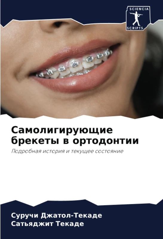 Самолигирующие брекеты в ортодонтии: Подробная история и текущее состояние: Podrobnaq istoriq i tekuschee sostoqnie