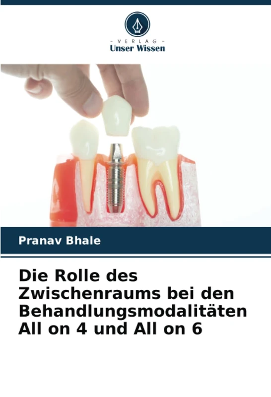 Die Rolle des Zwischenraums bei den Behandlungsmodalitäten All on 4 und All on 6 - Image 1