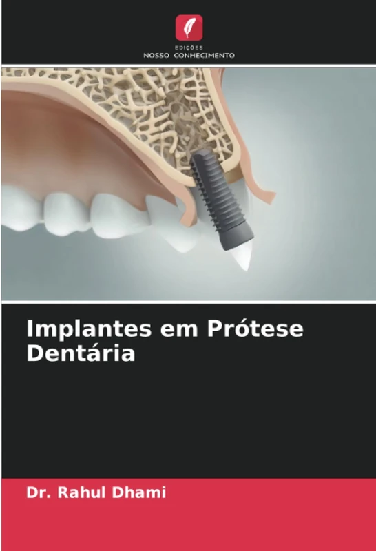 Implantes em Prótese Dentária