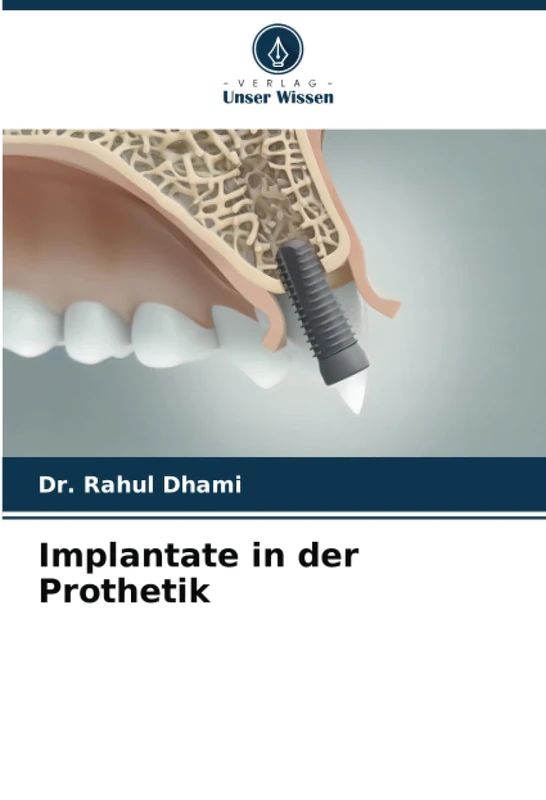 Implantate in der Prothetik