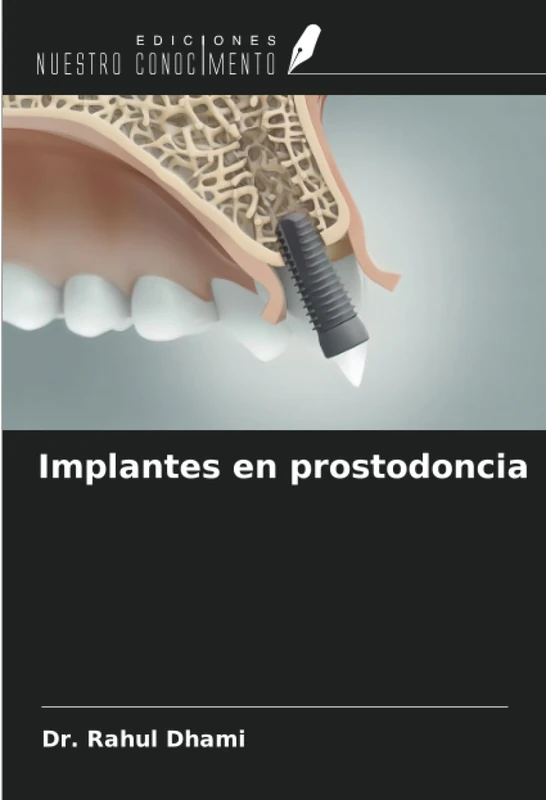 Implantes en prostodoncia