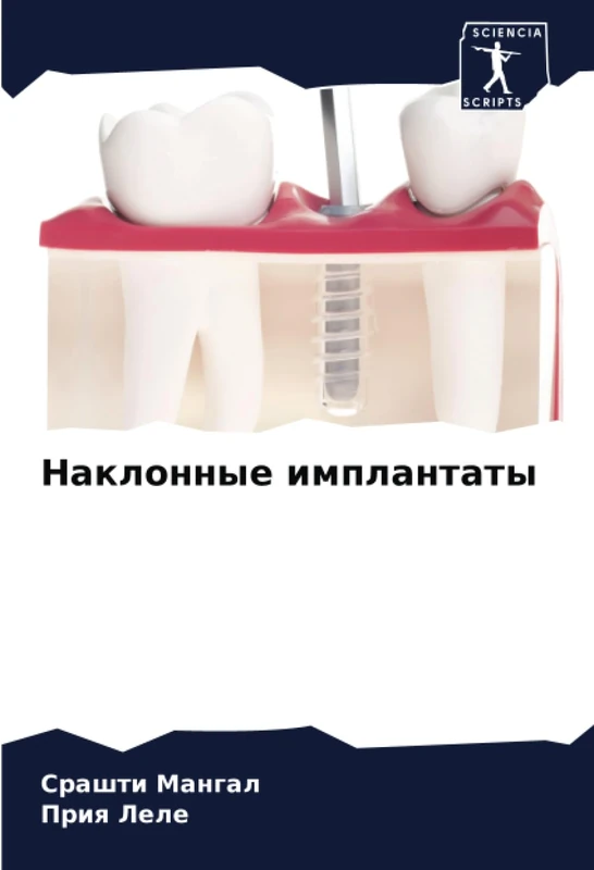 Наклонные имплантаты