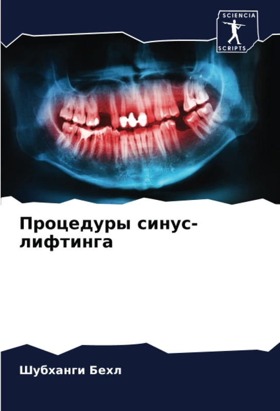 Процедуры синус-лифтинга