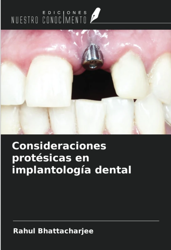 Consideraciones protésicas en implantología dental