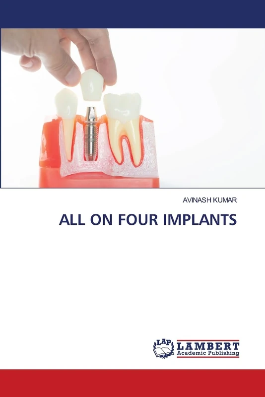 ALL ON FOUR IMPLANTS - Image 1