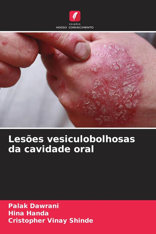 Lesões vesiculobolhosas da cavidade oral