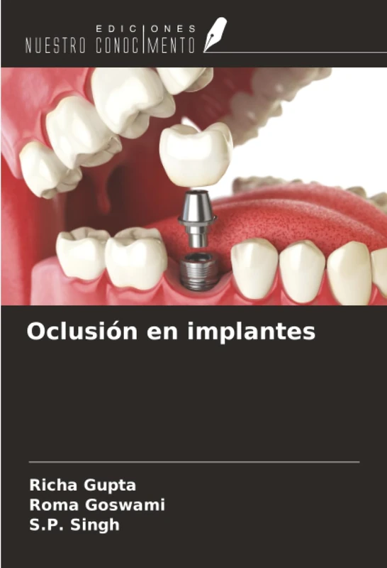Oclusión en implantes