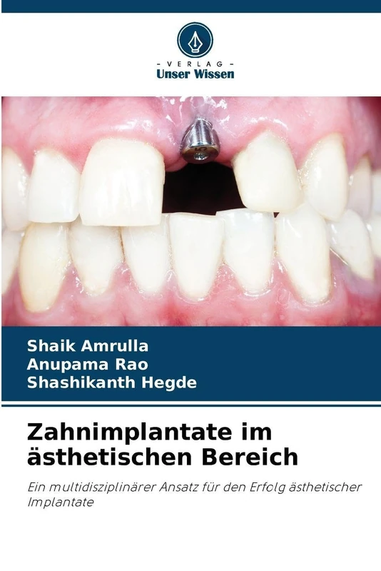 Zahnimplantate im ästhetischen Bereich: Ein multidisziplinärer Ansatz für den Erfolg ästhetischer Implantate