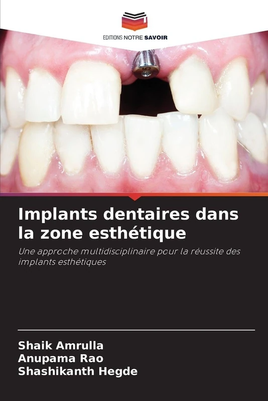 Implants dentaires dans la zone esthétique: Une approche multidisciplinaire pour la réussite des implants esthétiques