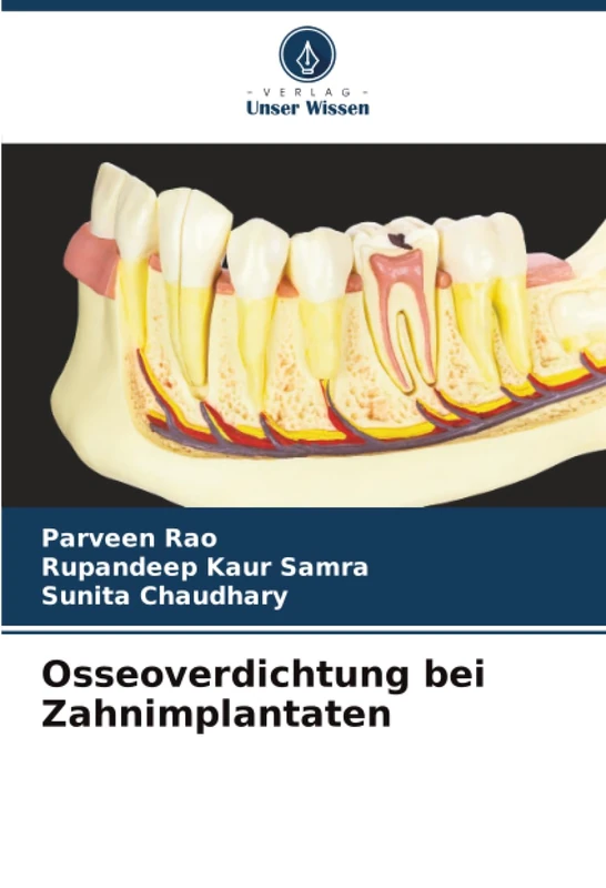 Osseoverdichtung bei Zahnimplantaten