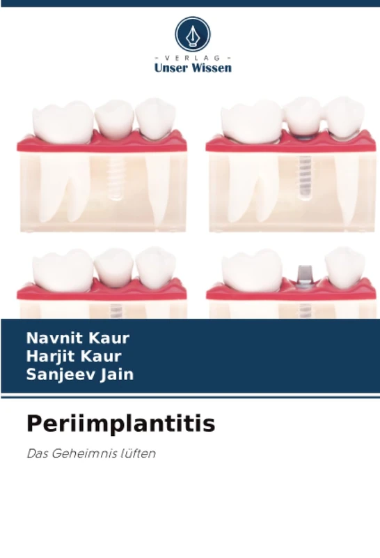 Periimplantitis: Das Geheimnis lüften