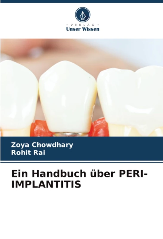 Ein Handbuch über PERI-IMPLANTITIS