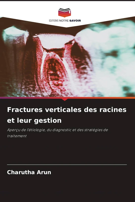 Fractures verticales des racines et leur gestion: Aperçu de l'étiologie, du diagnostic et des stratégies de traitement