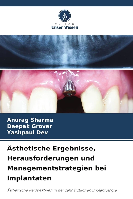 Ästhetische Ergebnisse, Herausforderungen und Managementstrategien bei Implantaten: Ästhetische Perspektiven in der zahnärztlichen Implantologie