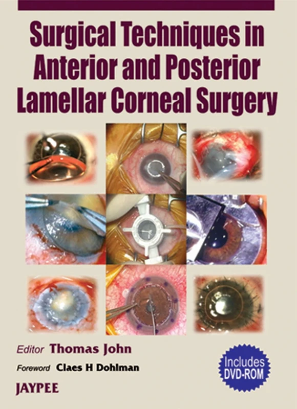Surgery Technique in Anterior and Post. Lamellar Corneal Surgery