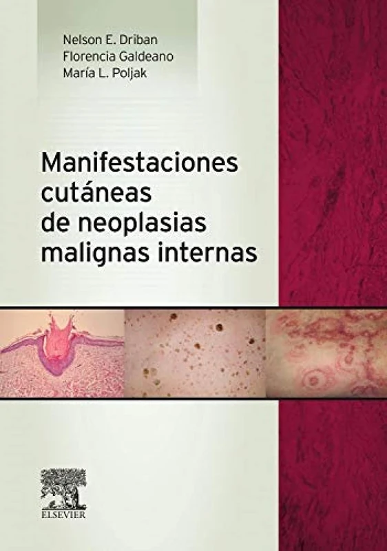 Manifestaciones cutáneas de neoplasias malignas internas - Image 1