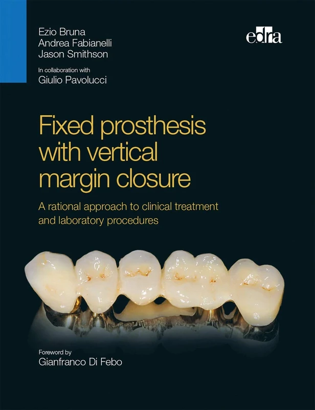 Fixed prosthesis with vertical margin closure - Image 1