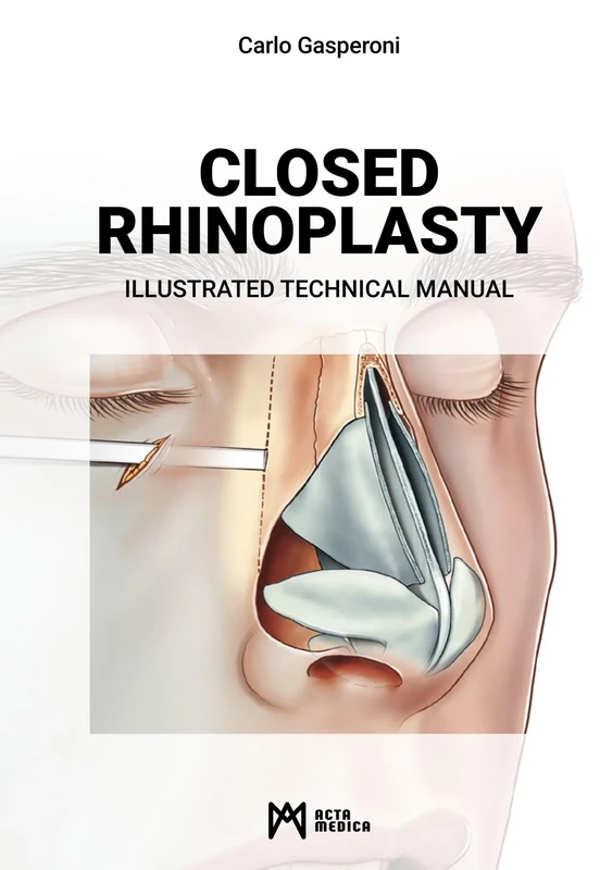 Closed Rhinoplasty: Illustrated Technical Manual - Image 1