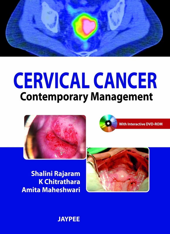 Cervical Cancer: Contemporary Management