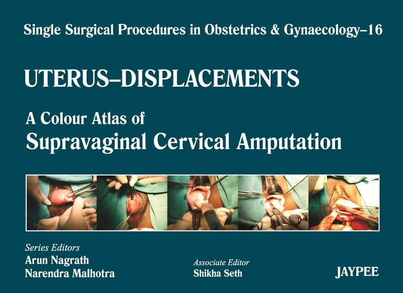 SSPOBGYB- Uterus Displacements 16: A Colour Atlas of Supravaginal Cervical Amputation (Nadkarni’s) (Single Surgical Procedures in Obstetrics and Gynaecology)