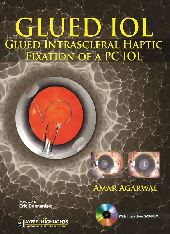 GLUED IOL Glued Intrascleral Haptic Fixation of a PC IOL