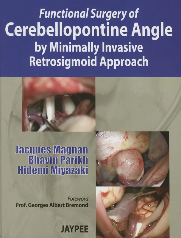 Functional Surgery of Cerebellopontine Angle by Minimally Invasive Retrosigmoid Approach - Image 1