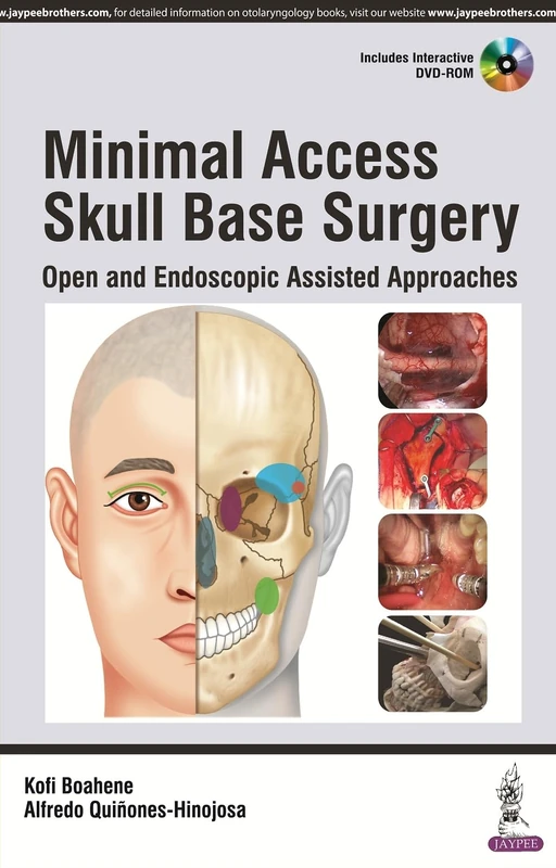 Minimal Access Skull Base Surgery Open and Endoscopic Assisted Approaches